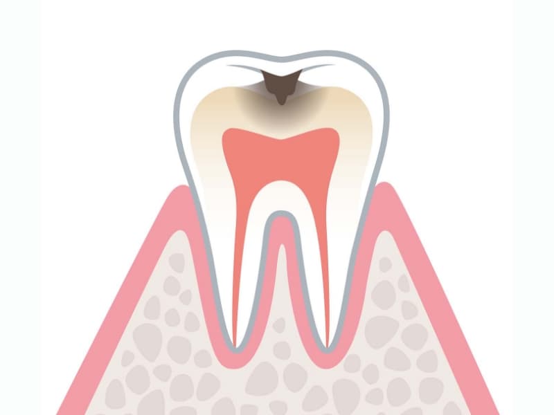 中期の虫歯