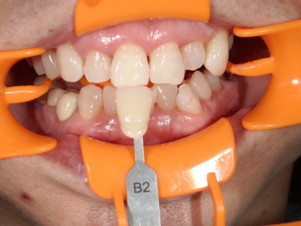 あと一歩歯を白く！オパールエッセンスブーストなら可能です